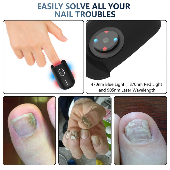 Danoz Health - Just In, Nail Fungus Laser Device Toenail Laser Therapy Machine Anti Fungal Laser USB Charge