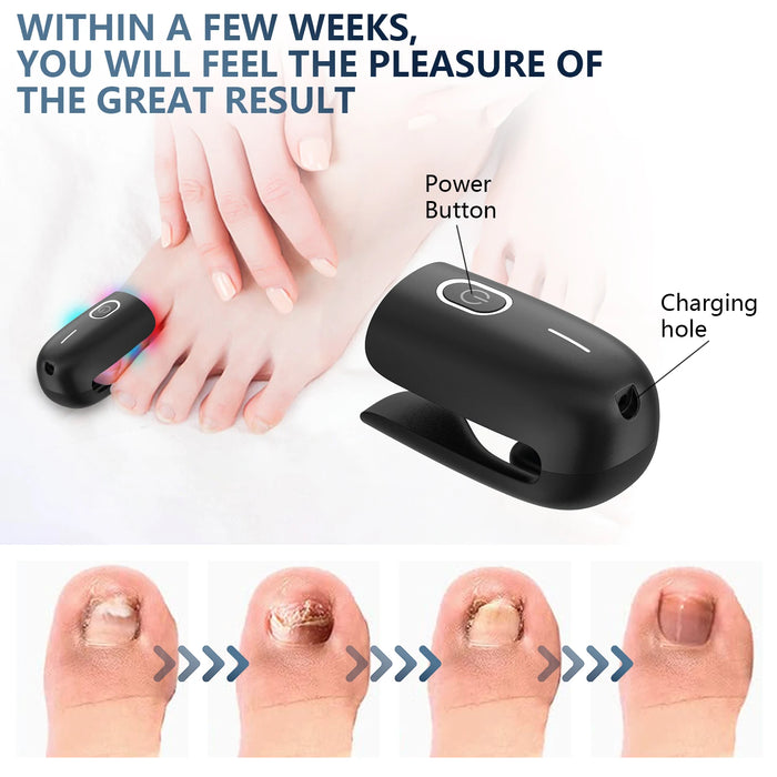 Danoz Health - Just In, Nail Fungus Laser Device Toenail Laser Therapy Machine Anti Fungal Laser USB Charge