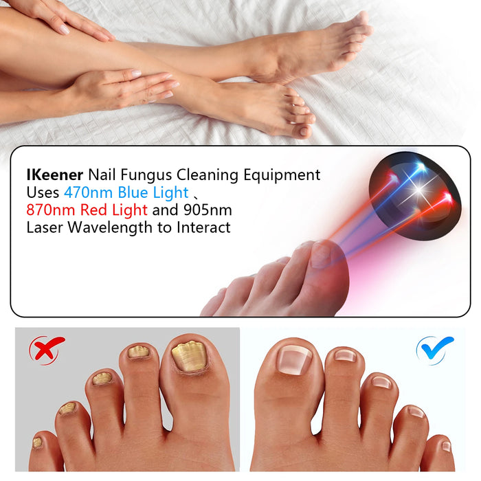 Danoz Health - Just In, Nail Fungus Laser Device Toenail Laser Therapy Machine Anti Fungal Laser USB Charge