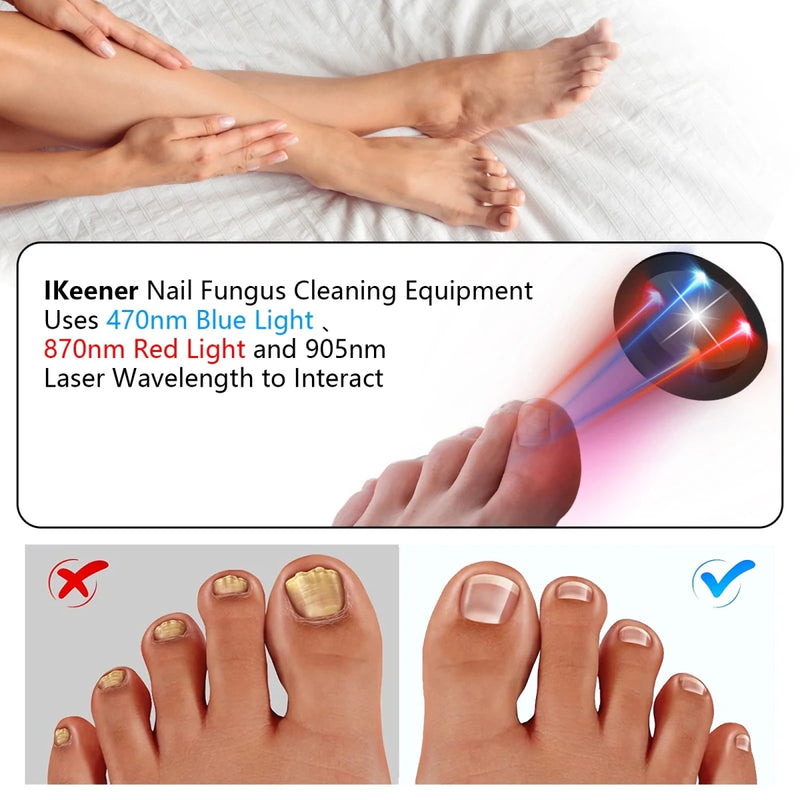 Danoz Health - Just In, Nail Fungus Laser Device Toenail Laser Therapy Machine Anti Fungal Laser USB Charge - danozdirect