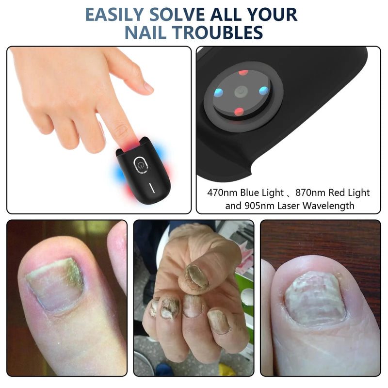 Danoz Health - Just In, Nail Fungus Laser Device Toenail Laser Therapy Machine Anti Fungal Laser USB Charge - danozdirect